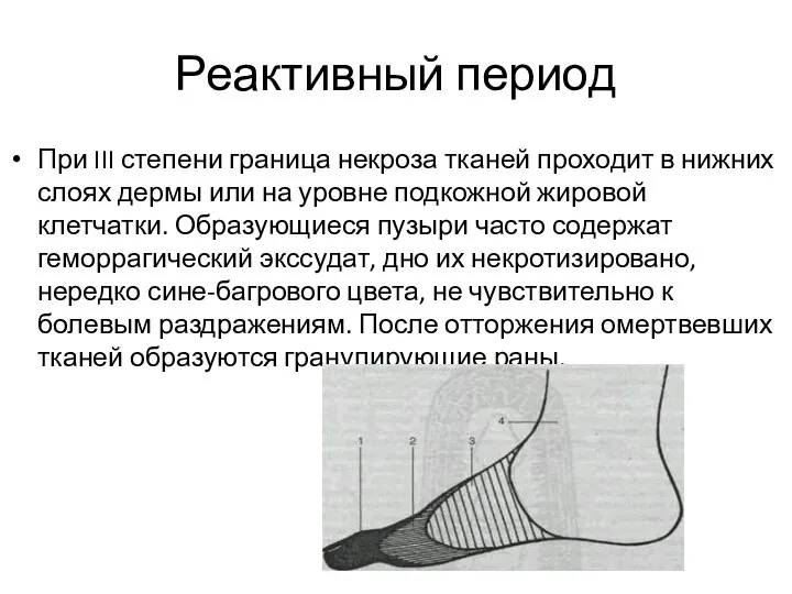 Реактивный период При III степени граница некроза тканей проходит в