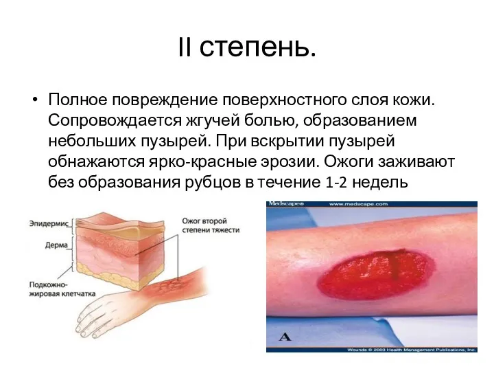 II степень. Полное повреждение поверхностного слоя кожи. Сопровождается жгучей болью,