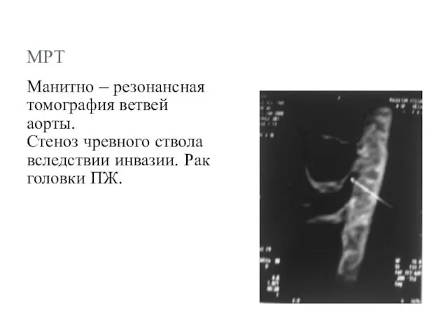 МРТ Манитно – резонансная томография ветвей аорты. Стеноз чревного ствола вследствии инвазии. Рак головки ПЖ.