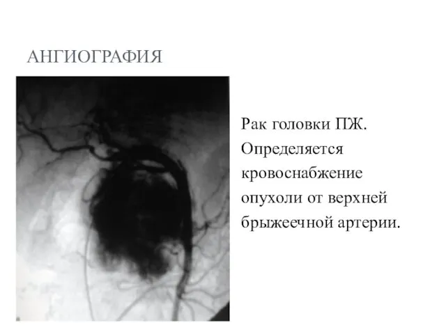 АНГИОГРАФИЯ Рак головки ПЖ. Определяется кровоснабжение опухоли от верхней брыжеечной артерии.