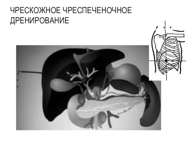 ЧРЕСКОЖНОЕ ЧРЕСПЕЧЕНОЧНОЕ ДРЕНИРОВАНИЕ