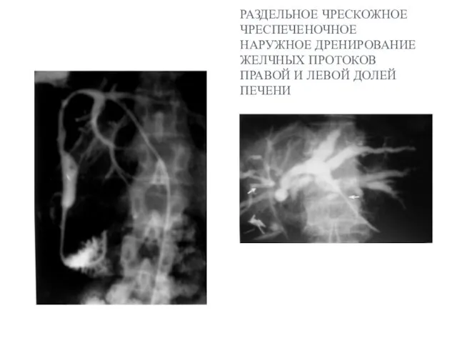 РАЗДЕЛЬНОЕ ЧРЕСКОЖНОЕ ЧРЕСПЕЧЕНОЧНОЕ НАРУЖНОЕ ДРЕНИРОВАНИЕ ЖЕЛЧНЫХ ПРОТОКОВ ПРАВОЙ И ЛЕВОЙ ДОЛЕЙ ПЕЧЕНИ