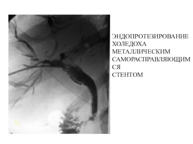 ЭНДОПРОТЕЗИРОВАНИЕ ХОЛЕДОХА МЕТАЛЛИЧЕСКИМ САМОРАСПРАВЛЯЮЩИМСЯ СТЕНТОМ б)