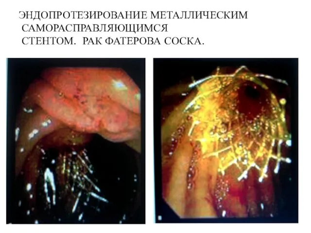 ЭНДОПРОТЕЗИРОВАНИЕ МЕТАЛЛИЧЕСКИМ САМОРАСПРАВЛЯЮЩИМСЯ СТЕНТОМ. РАК ФАТЕРОВА СОСКА.