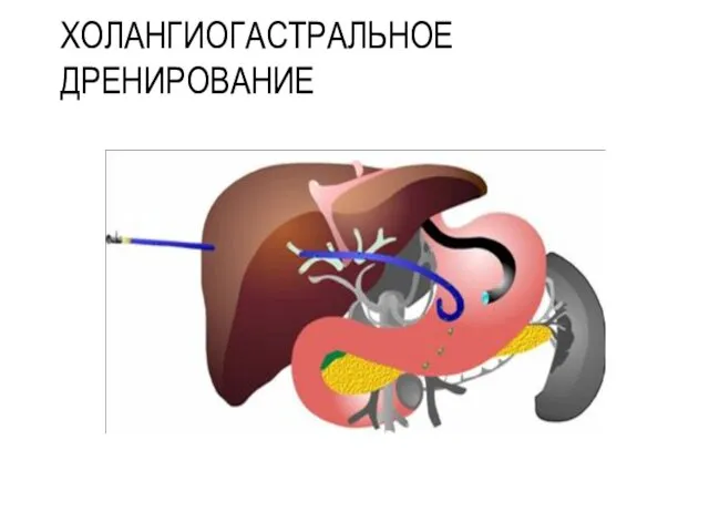 ХОЛАНГИОГАСТРАЛЬНОЕ ДРЕНИРОВАНИЕ