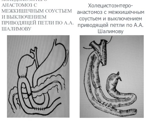 ХОЛЕДОХОЭНТЕРО- АНАСТОМОЗ С МЕЖКИШЕЧНЫМ СОУСТЬЕМ И ВЫКЛЮЧЕНИЕМ ПРИВОДЯЩЕЙ ПЕТЛИ ПО