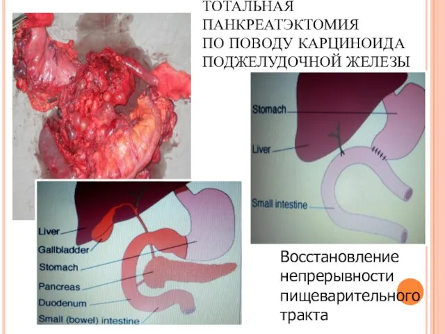 ТОТАЛЬНАЯ ПАНКРЕАТЭКТОМИЯ ПО ПОВОДУ КАРЦИНОИДА ПОДЖЕЛУДОЧНОЙ ЖЕЛЕЗЫ Восстановление непрерывности пищеварительного тракта