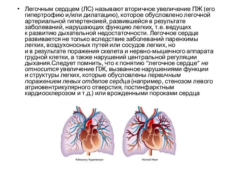 Легочным сердцем (ЛС) называют вторичное увеличение ПЖ (его гипертрофию и/или дилатацию), которое обусловлено