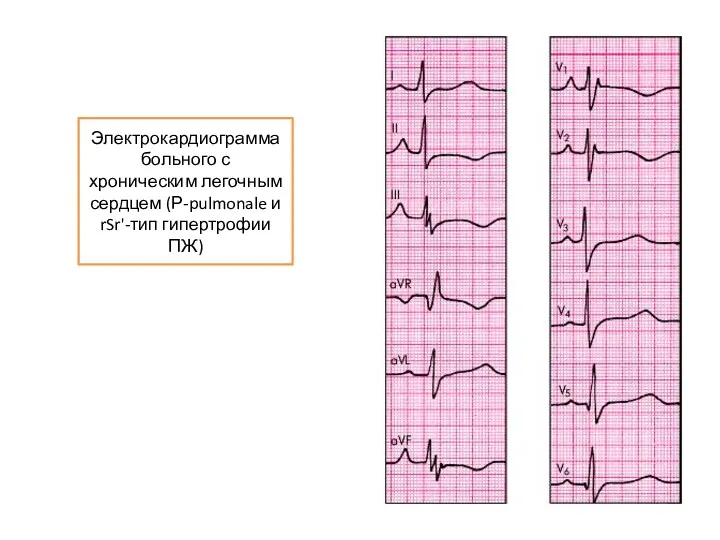 Электрокардиограмма больного с хроническим легочным сердцем (Р-pulmonale и rSr'-тип гипертрофии ПЖ)