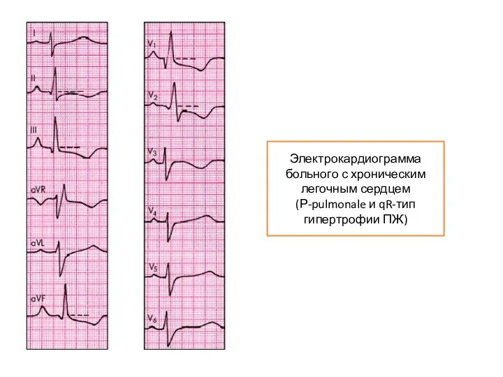Электрокардиограмма больного с хроническим легочным сердцем (Р-pulmonale и qR-тип гипертрофии ПЖ)