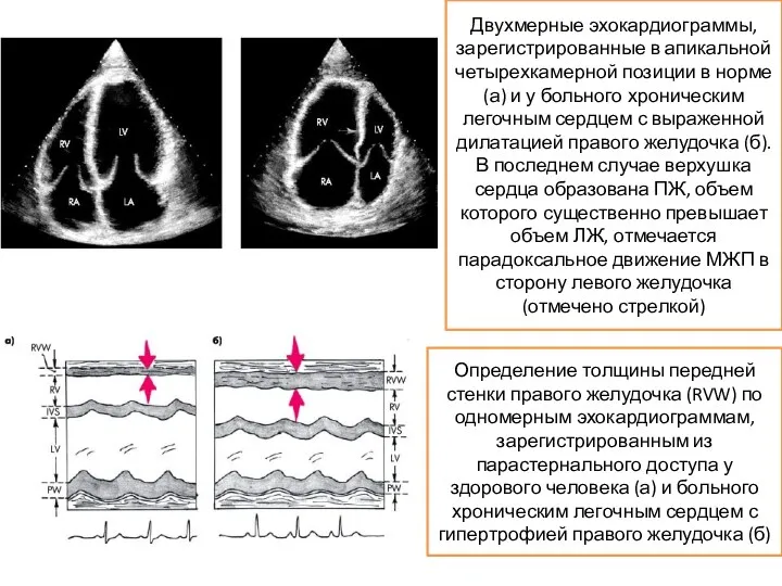 Двухмерные эхокардиограммы, зарегистрированные в апикальной четырехкамерной позиции в норме (а)