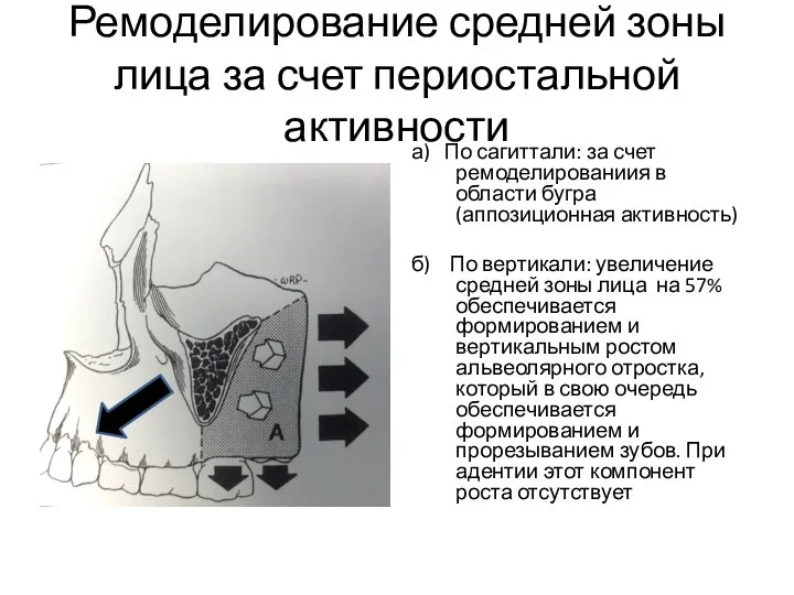 Ремоделирование средней зоны лица за счет периостальной активности а) По