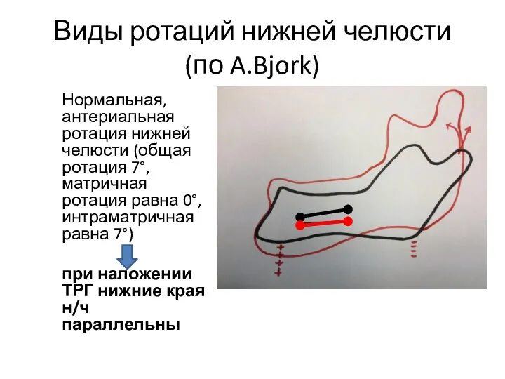 Виды ротаций нижней челюсти (по A.Bjork) Нормальная, антериальная ротация нижней