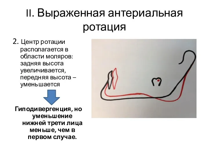 II. Выраженная антериальная ротация 2. Центр ротации располагается в области