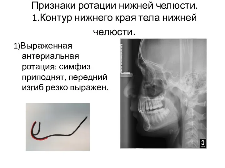 Признаки ротации нижней челюсти. 1.Контур нижнего края тела нижней челюсти.