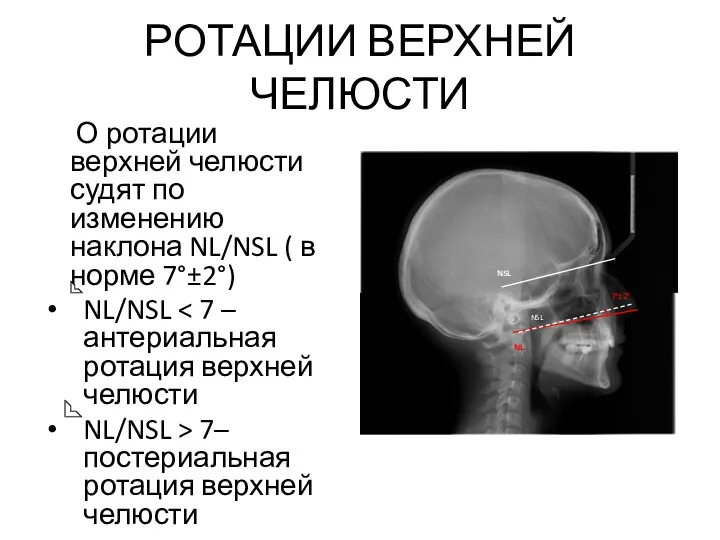 РОТАЦИИ ВЕРХНЕЙ ЧЕЛЮСТИ О ротации верхней челюсти судят по изменению