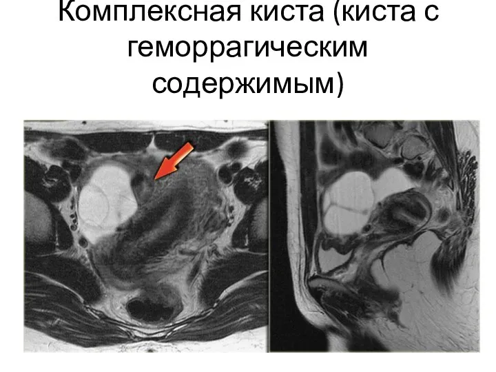 Комплексная киста (киста с геморрагическим содержимым)