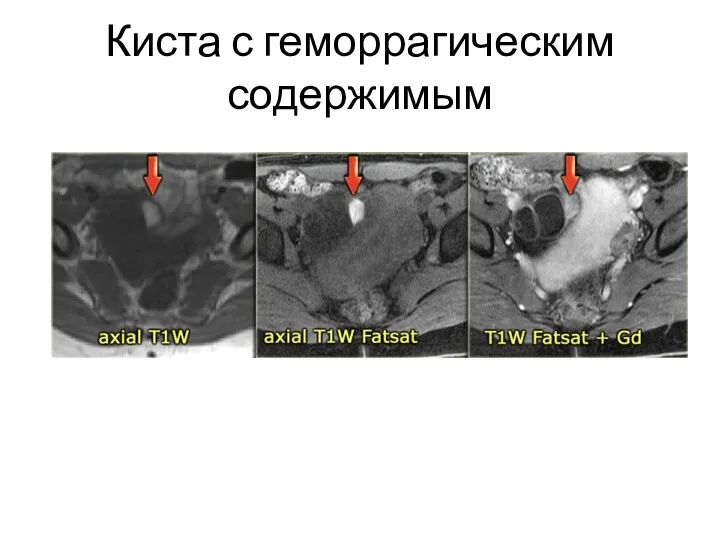 Киста с геморрагическим содержимым