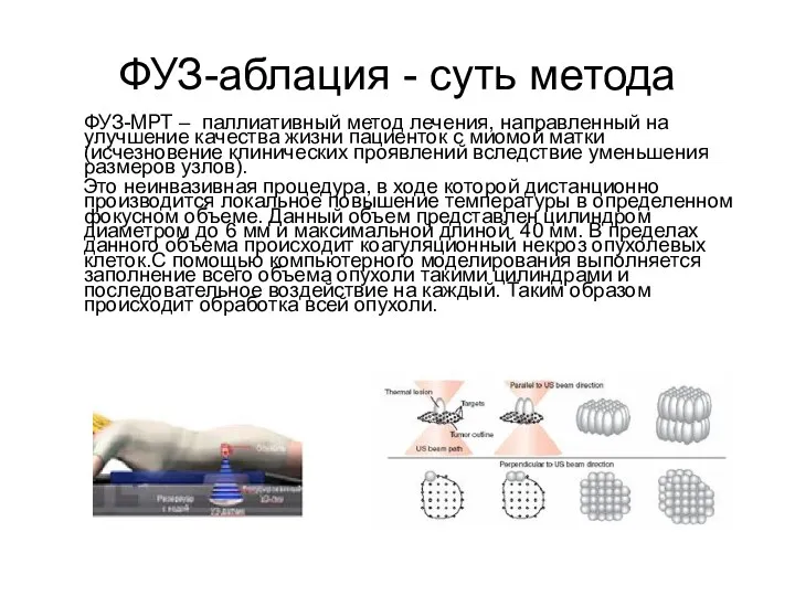 ФУЗ-аблация - суть метода ФУЗ-МРТ – паллиативный метод лечения, направленный