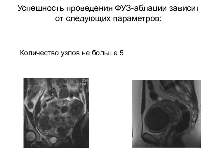 Успешность проведения ФУЗ-аблации зависит от следующих параметров: Количество узлов не больше 5