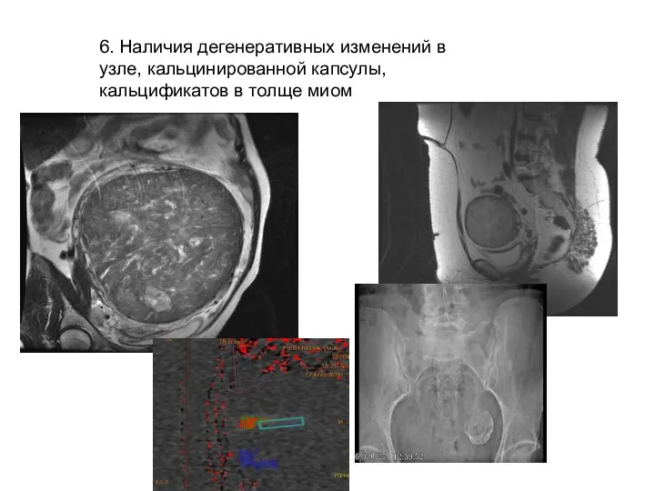 6. Наличия дегенеративных изменений в узле, кальцинированной капсулы, кальцификатов в толще миом