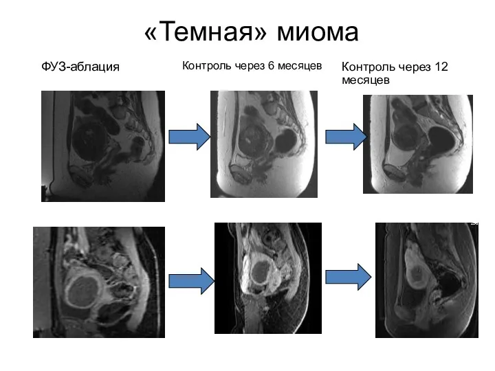 «Темная» миома ФУЗ-аблация Контроль через 6 месяцев Контроль через 12 месяцев