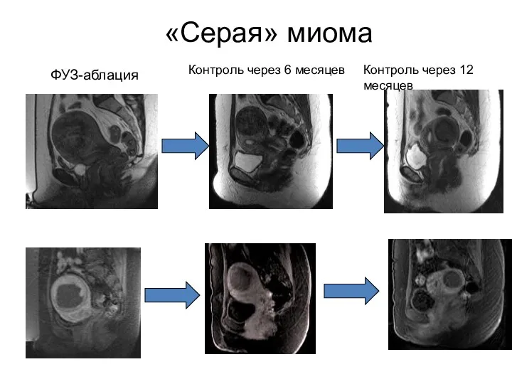 «Серая» миома ФУЗ-аблация Контроль через 6 месяцев Контроль через 12 месяцев