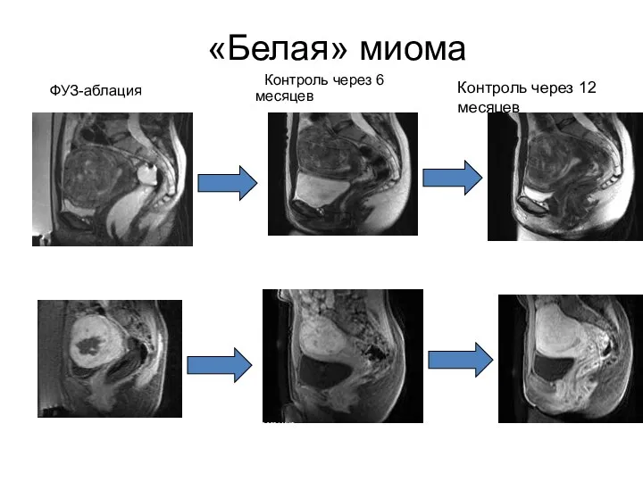 «Белая» миома ФУЗ-аблация Контроль через 6 месяцев Контроль через 12 месяцев