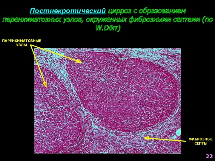 Постнекротический цирроз с образованием паренхиматозных узлов, окруженных фиброзными септами (по W.Dörr) ПАРЕНХИМАТОЗНЫЕ УЗЛЫ ФИБРОЗНЫЕ СЕПТЫ 22