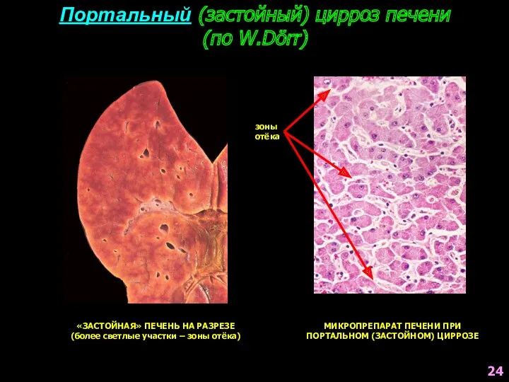Портальный (застойный) цирроз печени (по W.Dörr) «ЗАСТОЙНАЯ» ПЕЧЕНЬ НА РАЗРЕЗЕ