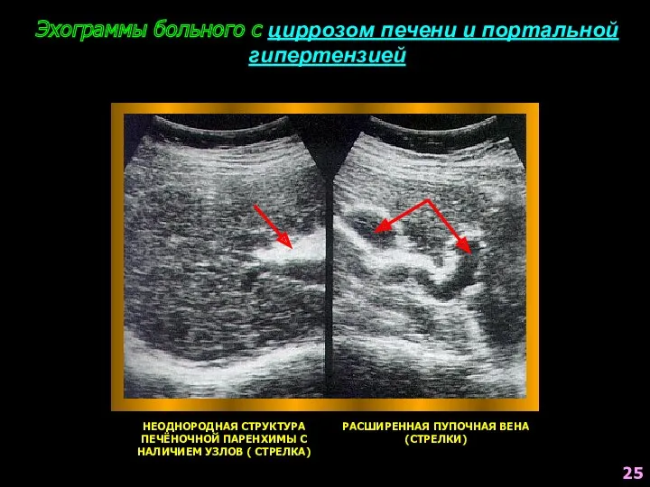 Эхограммы больного с циррозом печени и портальной гипертензией НЕОДНОРОДНАЯ СТРУКТУРА