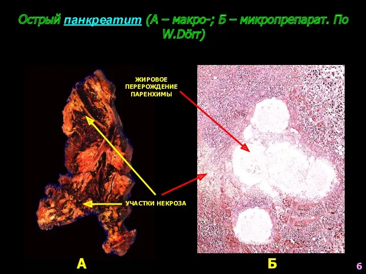 Острый панкреатит (А – макро-; Б – микропрепарат. По W.Dörr)