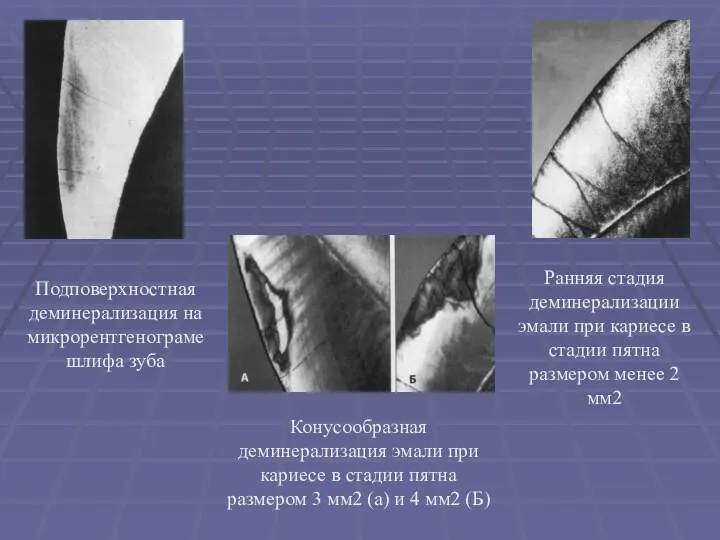 Подповерхностная деминерализация на микрорентгенограме шлифа зуба Ранняя стадия деминерализации эмали