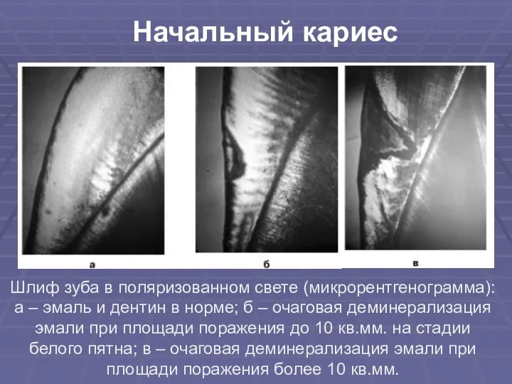 Шлиф зуба в поляризованном свете (микрорентгенограмма): а – эмаль и