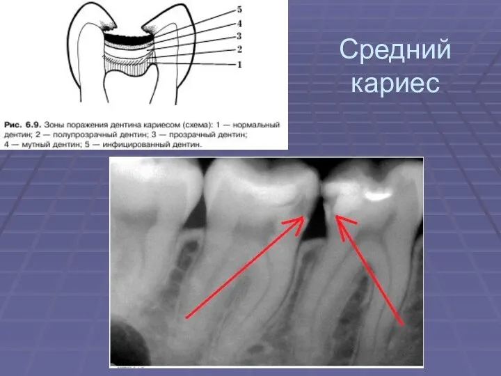 Средний кариес