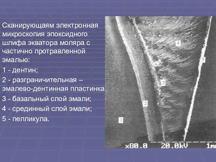 Сканирующаям электронная микроскопия эпоксидного шлифа экватора моляра с частично протравленной