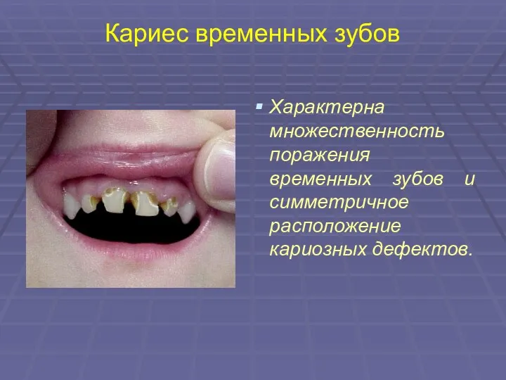 Кариес временных зубов Характерна множественность поражения временных зубов и симметричное расположение кариозных дефектов.