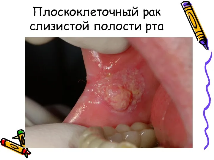Плоскоклеточный рак слизистой полости рта