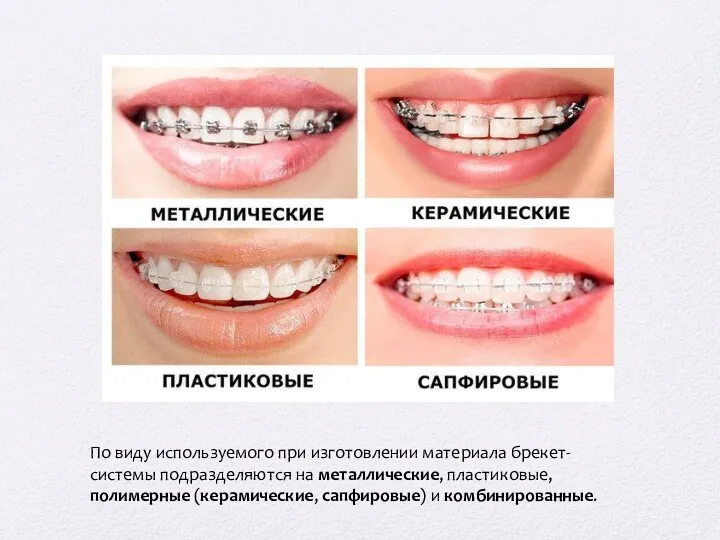 По виду используемого при изготовлении материала брекет-системы подразделяются на металлические, пластиковые, полимерные (керамические, сапфировые) и комбинированные.