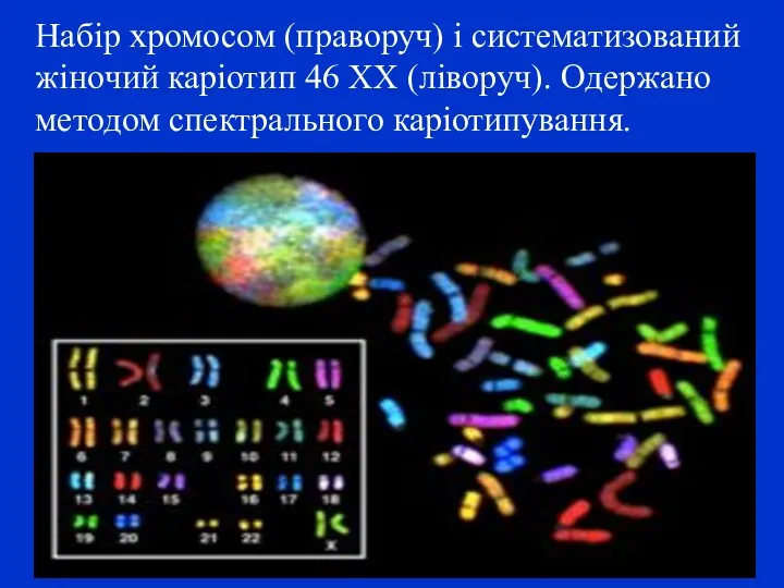 Набір хромосом (праворуч) і систематизований жіночий каріотип 46 XX (ліворуч). Одержано методом спектрального каріотипування.
