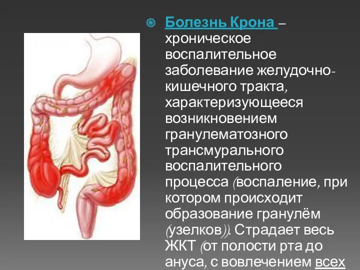 Болезнь Крона – хроническое воспалительное заболевание желудочно-кишечного тракта, характеризующееся возникновением