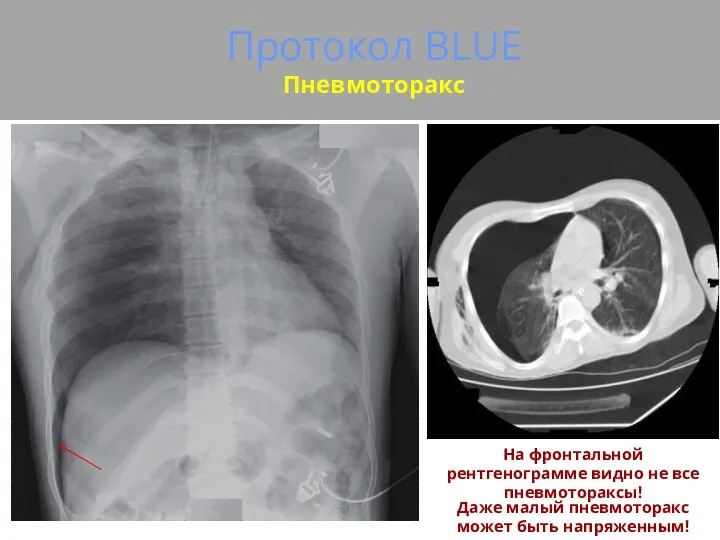 Протокол BLUE Пневмоторакс На фронтальной рентгенограмме видно не все пневмотораксы! Даже малый пневмоторакс может быть напряженным!