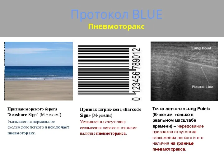 Протокол BLUE Пневмоторакс Признак штрих-кода «Barcode Sign» (М-режим) Указывает на отсутствие скольжения легкого