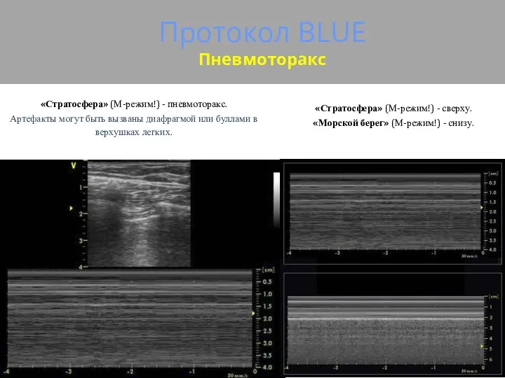 Протокол BLUE Пневмоторакс «Стратосфера» (М-режим!) - пневмоторакс. Артефакты могут быть вызваны диафрагмой или