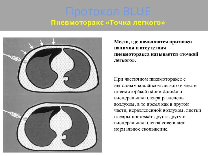 Протокол BLUE Пневмоторакс «Точка легкого» Место, где появляются признаки наличия и отсутствия пневмоторакса