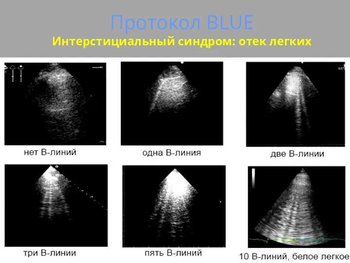 Протокол BLUE Интерстициальный синдром: отек легких