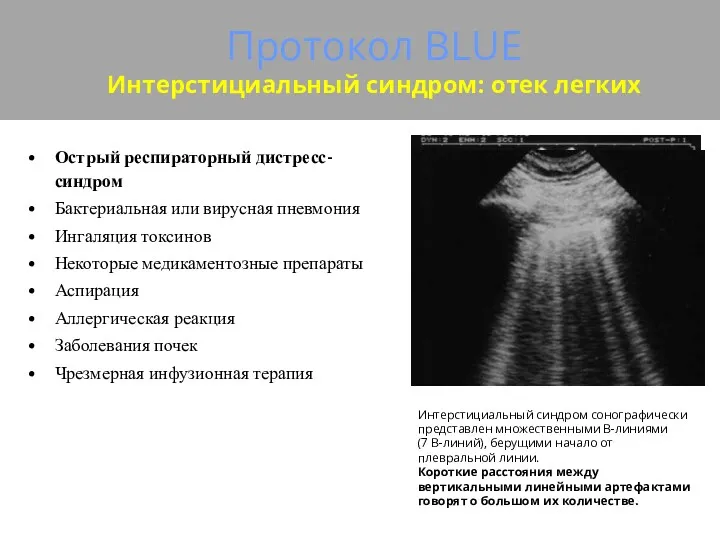 Протокол BLUE Интерстициальный синдром: отек легких Острый респираторный дистресс-синдром Бактериальная или вирусная пневмония