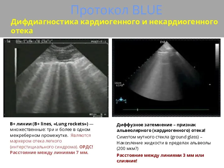 Протокол BLUE Дифдиагностика кардиогенного и некардиогенного отека В+ линии (В+ lines, «Lung rockets»)