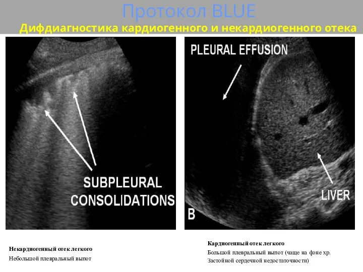 Протокол BLUE Дифдиагностика кардиогенного и некардиогенного отека Некардиогенный отек легкого Небольшой плевральный выпот