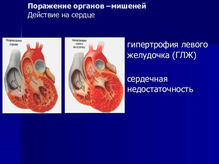 Поражение органов –мишеней Действие на сердце гипертрофия левого желудочка (ГЛЖ) сердечная недостаточность
